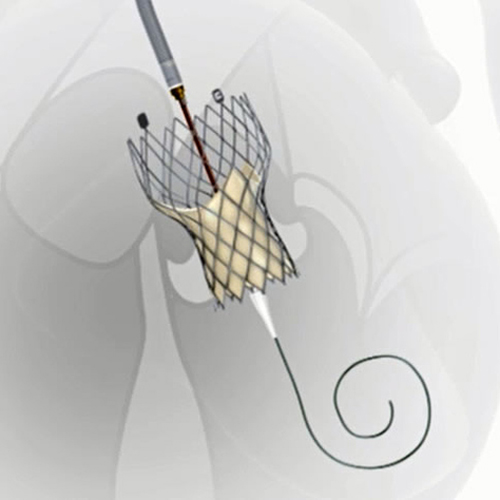 Транскатетеральная имплантация аортального клапана TAVR