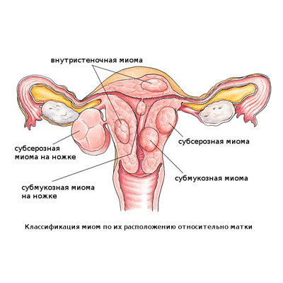 Как Выглядит Миома Фото