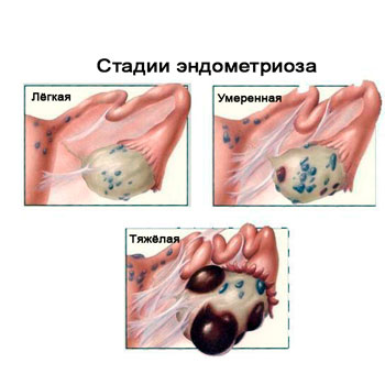 Как Выглядит Эндометриоз Фото