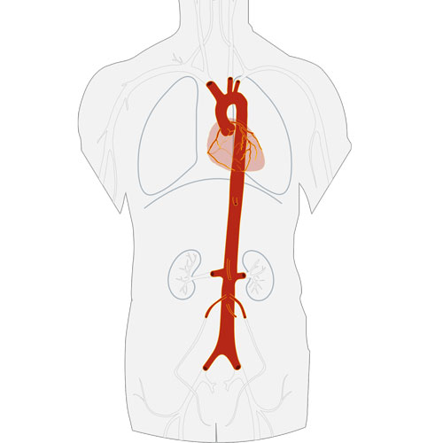 Хирургия грудной аорты