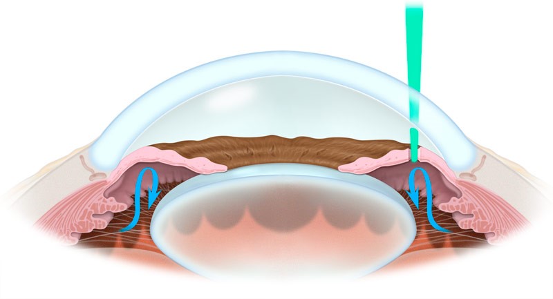 Результат лазерной антиглаукомной операции - лазерной трабекулопластика
