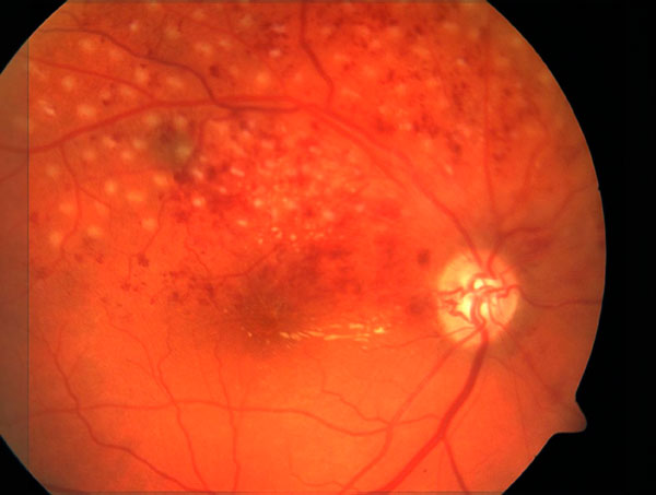 Вид глазного дна после лазерной коагуляции зоны посттромботической ангиоретинопатии
