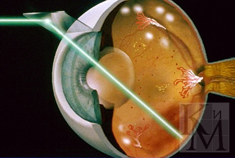 Технология лазерной коагуляции сетчатки глаза.