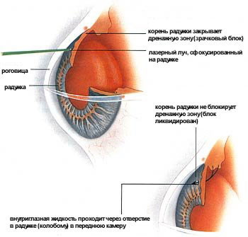 Результат лазерной антиглаукомной операции - лазерной иридэктомии