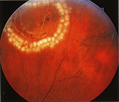 Вид глазного дна после успешно проведенной барьерной лазерной коагуляции вокруг участка дистрофии сетчатки с разрывом