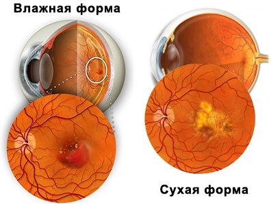 Возрастная макулодистрофия