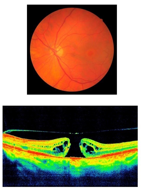 Сенильный макулярный разрыв Сенильный макулярный разрыв
