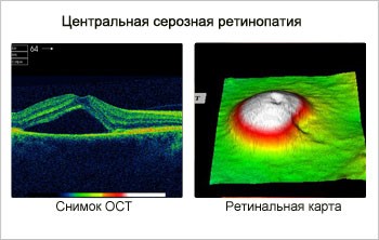 Центральная серозная хориоретинопатия