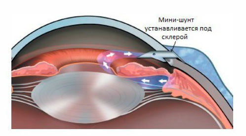 Лечение глаукомы лазером в минске thumbnail