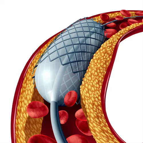 Ангиопластика