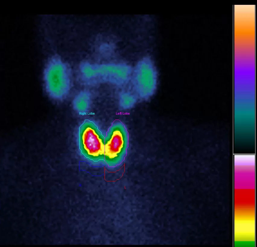 Исследование щитовидной железы