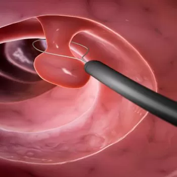 Удаление полипов тела и шейки матки, гиперплазии эндометрия