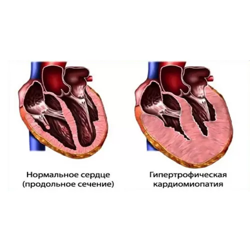 Хирургическое лечение гипертрофической кардиомиопатии (ГКМП)