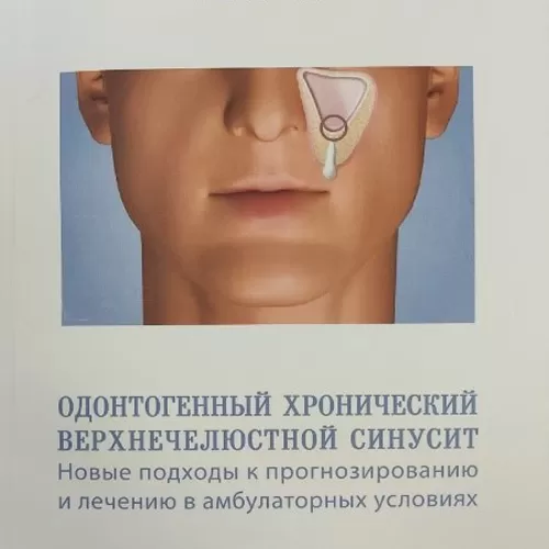 Одонтогенный хронический верхнечелюстной синусит. Новые подходы к прогнозированию и лечению в амбулаторных условиях