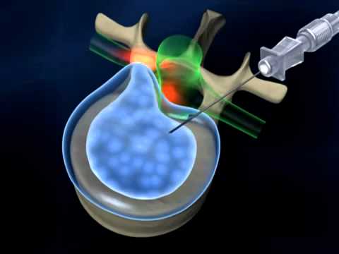 Высушивание грыжи позвоночника в минске